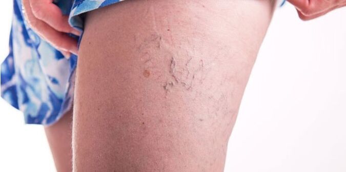 Varicose veins from the lower ends