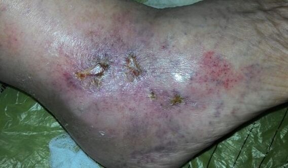 Varicose vein complications