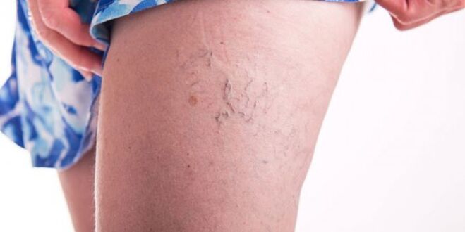 vein varicose veins