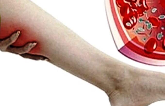 Vein varicose veins