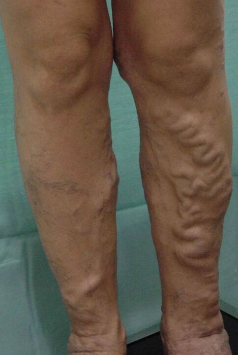 Varicose veins in the legs