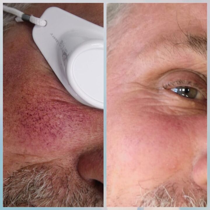 Varicose veins on the face