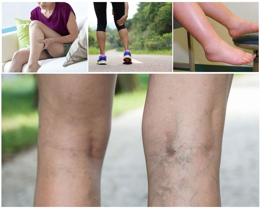 Varicosis Starting
