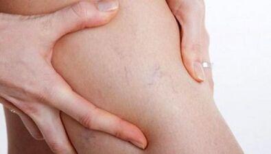 How varicose veins are manifested in the legs