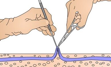Operation for veins varicose veins