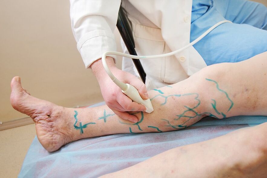 Preparation for miniphlebectomy - marking of leg perforators, performing ultrasound