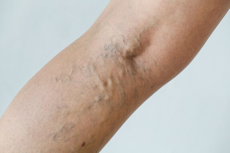Stage C2 – popliteal varices (Thierry perforator) and reticular veins
