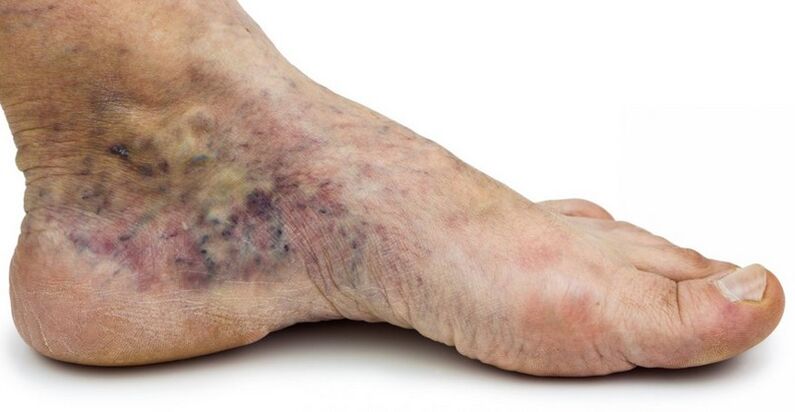 Stage C4c – crown of the foot, phlebitis in the center