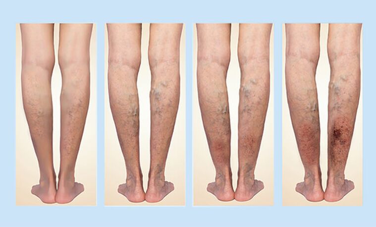Varicose veins